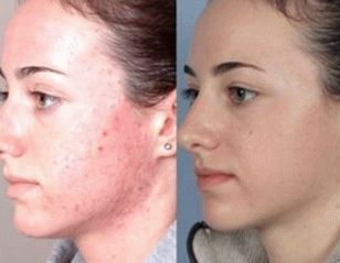 fotografija kože lica nakon tretmana psorijaze